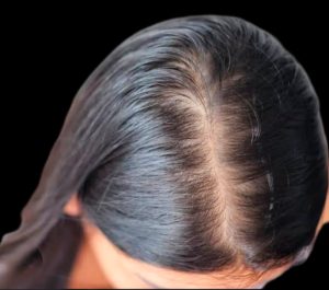 Hair Loss Treatment