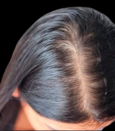 Hair Loss Treatment