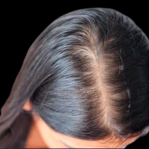 Hair Loss Treatment